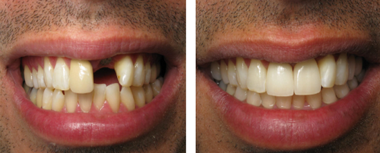 Cosmetic Dentistry Brooklyn, NY (718)404-9617